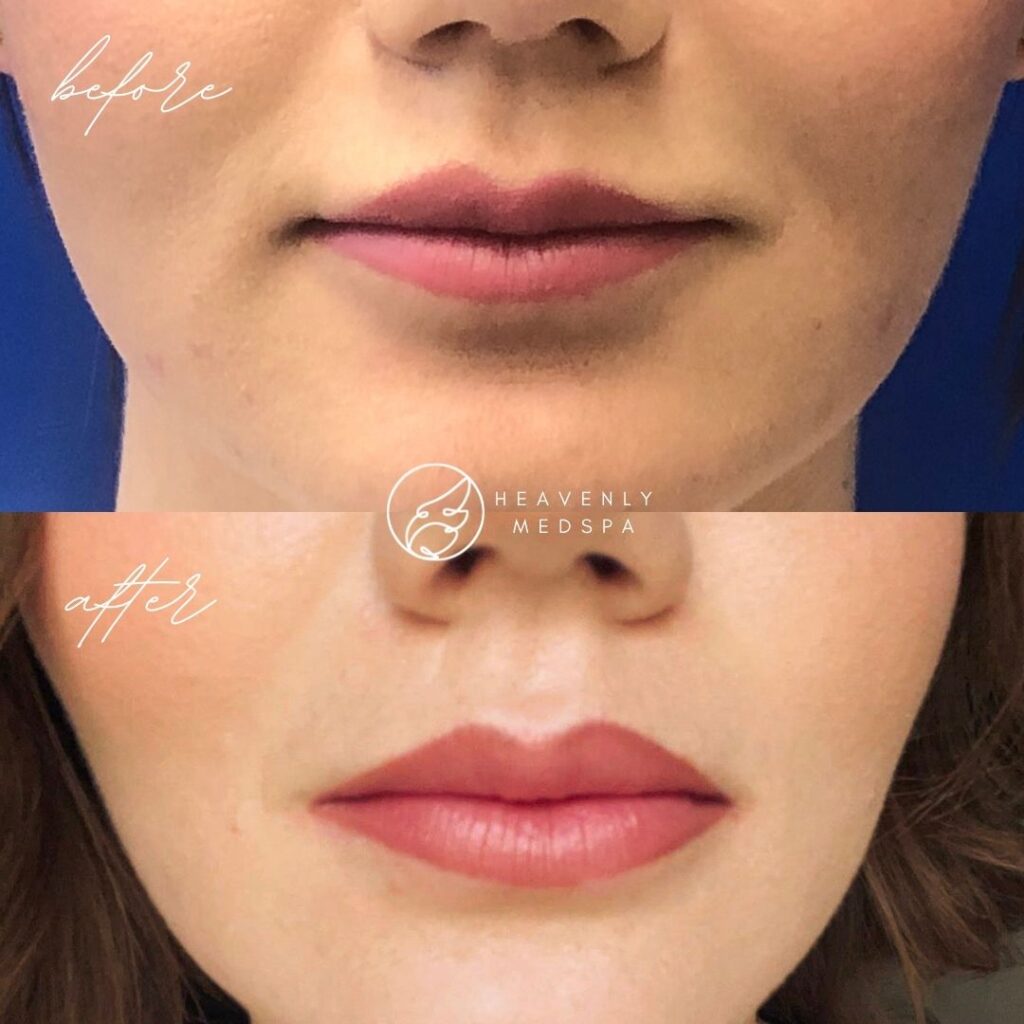 Lip flip, lip botox, no filler lip enhancement, lip enhancement, voluminous lips, lip flip orange county, lip flip before and after