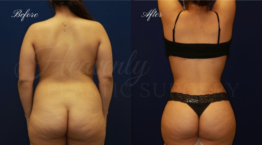 liposuction 360, lipo 360, arm liposuction, liposuction before and after, lipo 360 before and after, arm lipo before and after, chin lipo before and after, liposuction surgeon, liposuction orange county, chin lipo orange county, liposuction results, orange county plastic surgery, orange county plastic surgeon