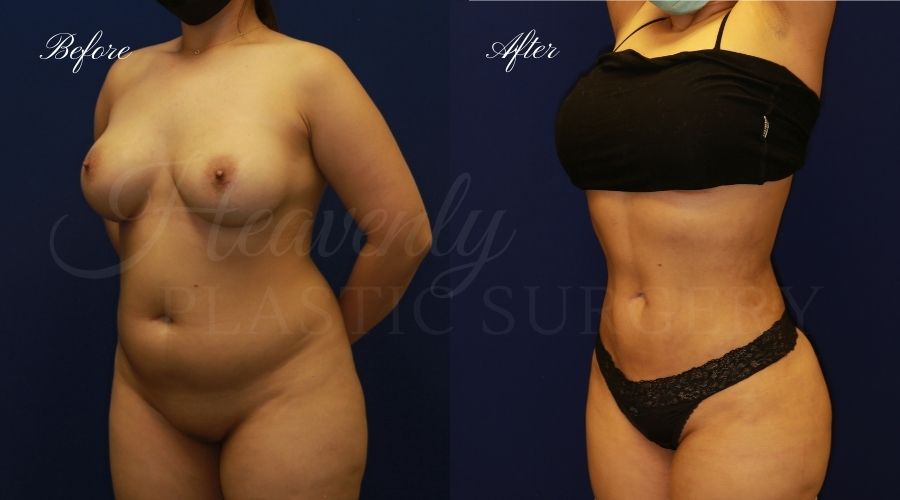 liposuction 360, lipo 360, arm liposuction, liposuction before and after, lipo 360 before and after, arm lipo before and after, chin lipo before and after, liposuction surgeon, liposuction orange county, chin lipo orange county, liposuction results, orange county plastic surgery, orange county plastic surgeon liposuction 360, lipo 360, arm liposuction, liposuction before and after, lipo 360 before and after, arm lipo before and after, chin lipo before and after, liposuction surgeon, liposuction orange county, chin lipo orange county, liposuction results, orange county plastic surgery, orange county plastic surgeon