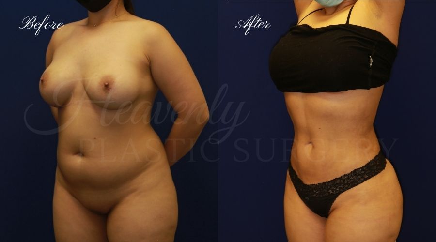 liposuction 360, lipo 360, arm liposuction, liposuction before and after, lipo 360 before and after, arm lipo before and after, chin lipo before and after, liposuction surgeon, liposuction orange county, chin lipo orange county, liposuction results, orange county plastic surgery, orange county plastic surgeon