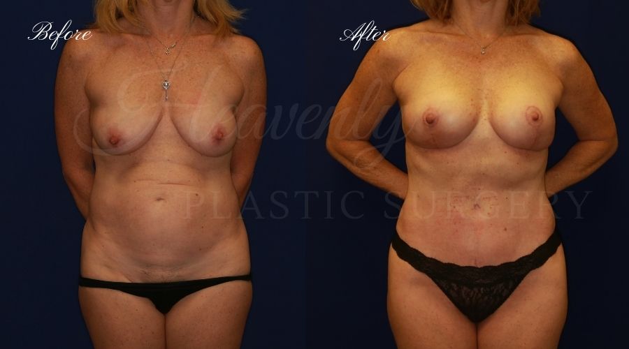 Heavenly Plastic Surgery, Plastic Surgery, Plastic Surgeon, Mommy Makeover, Transformation, Breast Lift, Tummy Tuck, Breast lift without implants, Breast Surgery, Body Surgery, Tummy Tuck, Tummy Tuck with Liposuction, Liposuction
