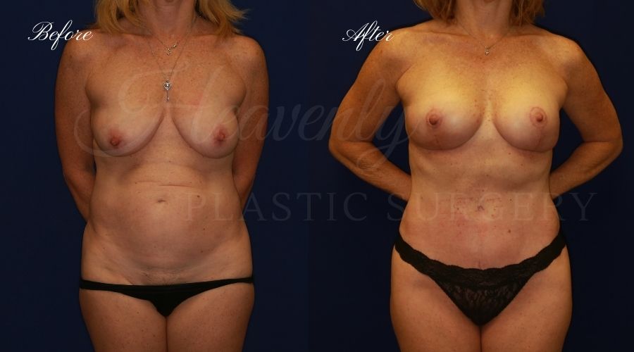 Heavenly Plastic Surgery, Plastic Surgery, Plastic Surgeon, Mommy Makeover, Transformation, Breast Lift, Tummy Tuck, Breast lift without implants, Breast Surgery, Body Surgery, Tummy Tuck, Tummy Tuck with Liposuction, Liposuction Heavenly Plastic Surgery, Plastic Surgery, Plastic Surgeon, Mommy Makeover, Transformation, Breast Lift, Tummy Tuck, Breast lift without implants, Breast Surgery, Body Surgery, Tummy Tuck, Tummy Tuck with Liposuction, Liposuction