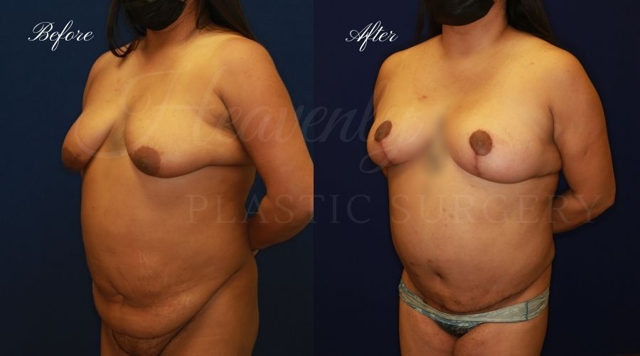 Heavenly Plastic Surgery, Plastic Surgery, Plastic Surgeon, Mommy Makeover, Transformation, Breast Lift, Tummy Tuck, Breast lift without implants, Breast Surgery, Body Surgery, Tummy Tuck, Tummy Tuck with Liposuction, Liposuction