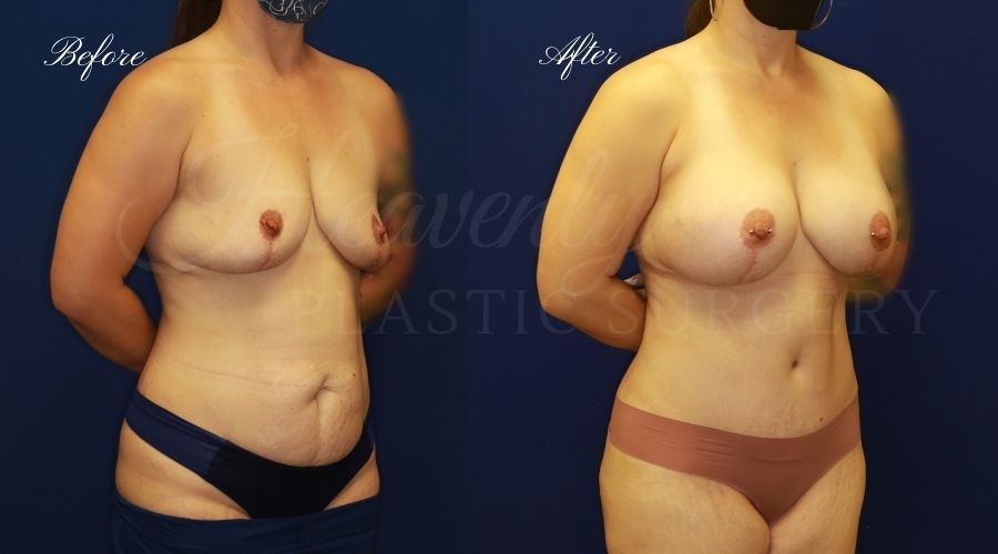 Mommy Makeover - Implant Exchange + Tummy Tuck Before and After, Mommy Makeover Orange County, Mommy Makeover Surgeon, Mommy Makeover Surgery