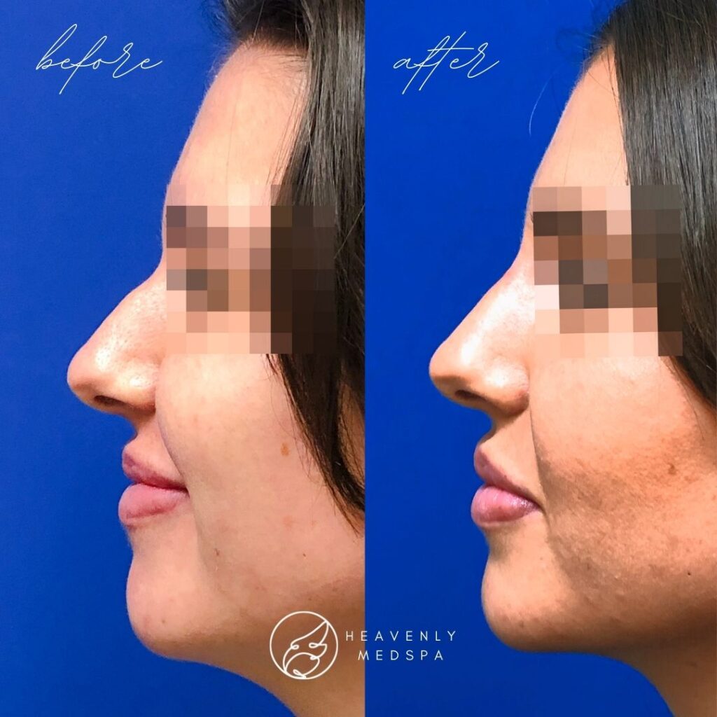 nose filler before and after, nose filler, nose filler orange county, non surgical rhinoplasty, non-surgical rhinoplasty, non surgical rhinoplasty orange county, dermal filler, nose dermal filler, hyaluronic acid filler