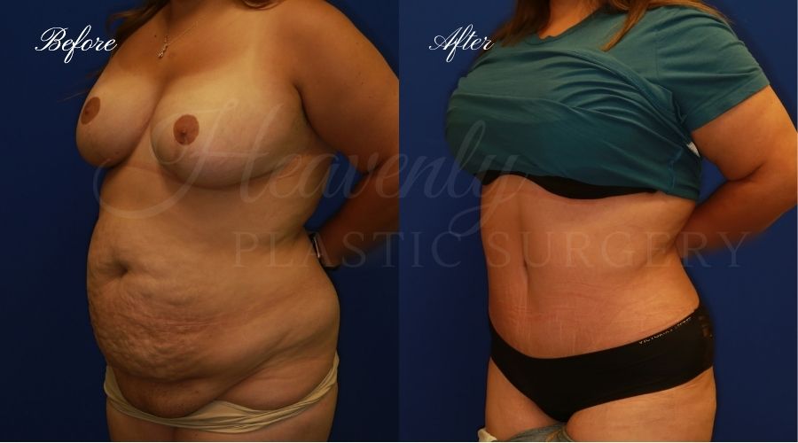 Plastic Surgery, Plastic Surgeon, Tummy Tuck, Abdominoplasty, Tummy Tuck with Lipo, Liposuction, Orange County Plastic Surgeon, Orange County Plastic Surgery, Fupa, Fupa surgery, fupa surgeon