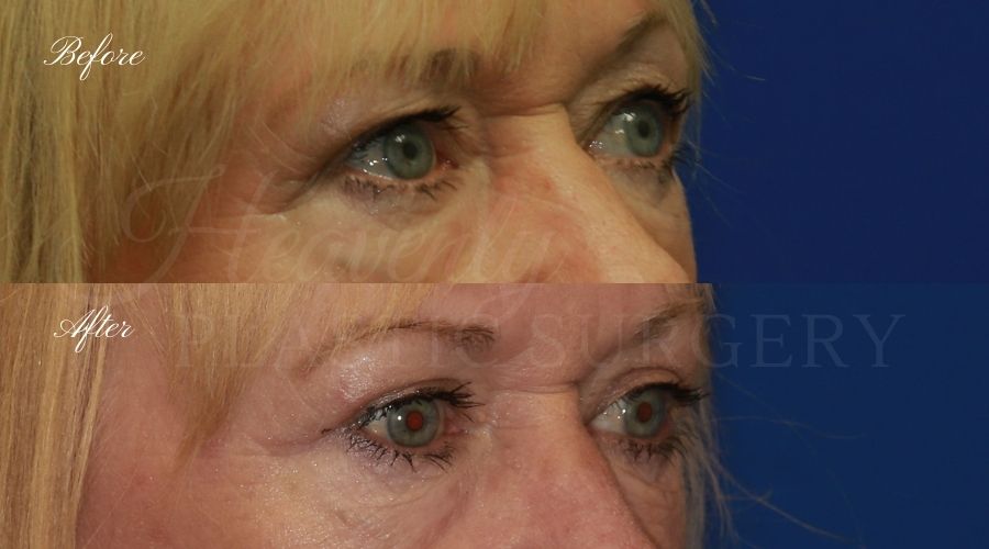 Plastic surgeon, plastic surgery, upper blepharoplasty, eyelid surgery