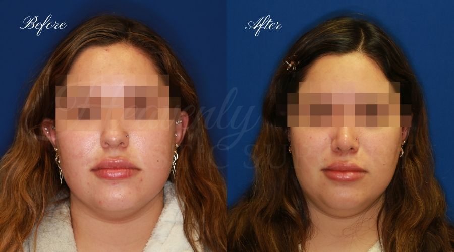 Patient 26207656, Buccal Fat Pad Removal Before & After Photos