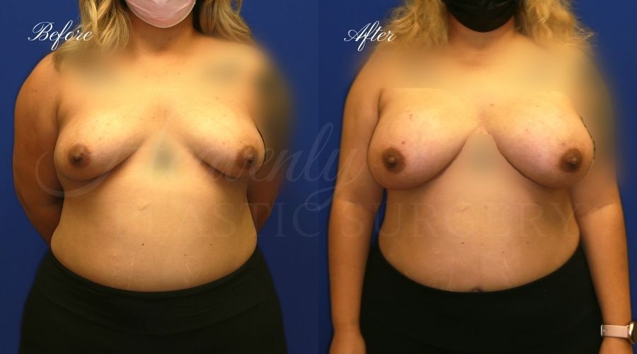 breast augmentation before and after, breast augmentation results, breast augmentation surgery, breast implants before and after, breast implants results, plastic surgery before and after, plastic surgery results, plastic surgeon, breast surgeon, breast augmentation surgeon, breast implant surgeon, breast implants orange county, breast augmentation orange county, orange county plastic surgeon, plastic surgery check