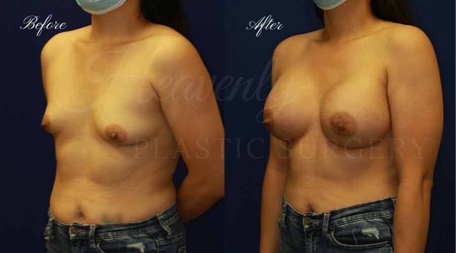 breast augmentation, breast augmentation surgery, breast augmentation surgeon, breast augmentation orange county, breast augmentation with silicone implants, sientra implants, boob job, boob job surgeon, breast implant surgeon, plastic surgery orange county, lake forest plastic surgeon, breast augmentation lake forest, south oc plastic surgeon