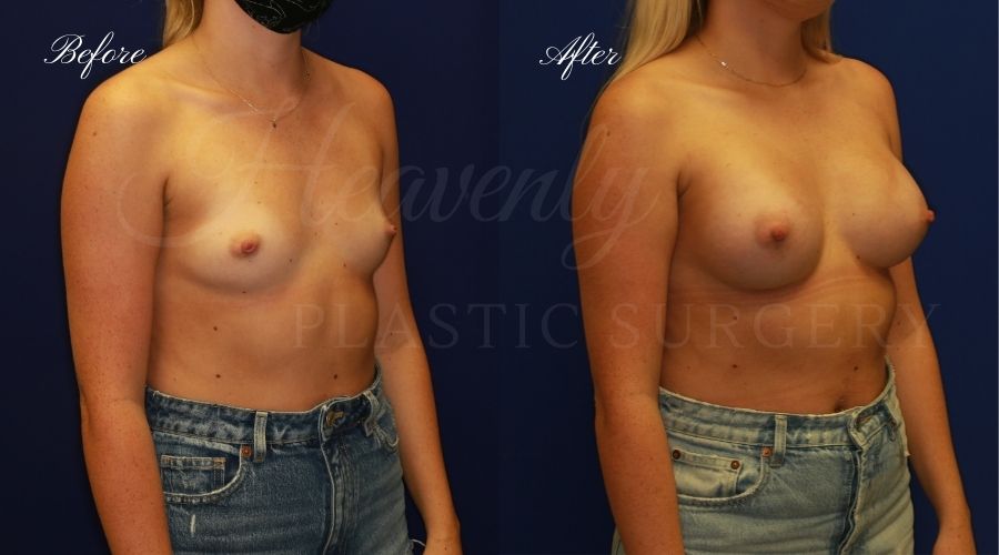 breast augmentation, breast augmentation surgery, breast augmentation surgeon, breast augmentation orange county, breast augmentation with silicone implants, sientra implants, boob job, boob job surgeon, breast implant surgeon, plastic surgery orange county, lake forest plastic surgeon, breast augmentation lake forest, south oc plastic surgeon