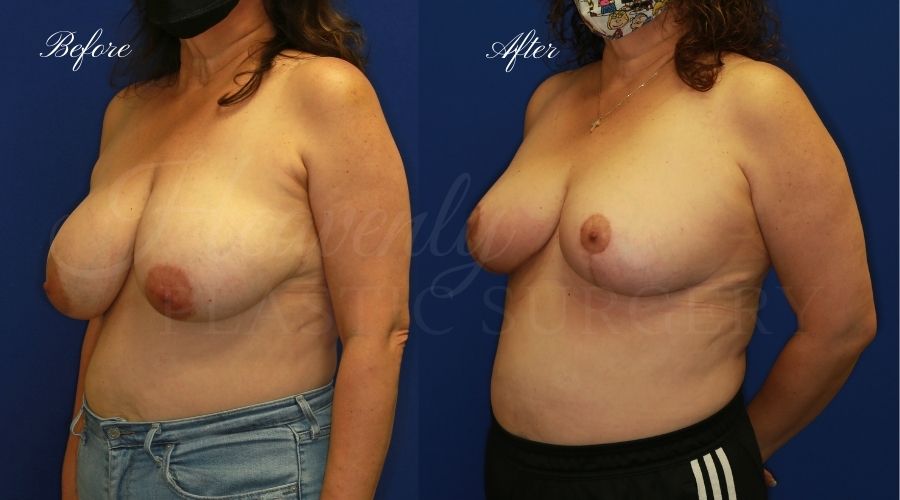 Breast lift surgery, breast lift, breast lift surgeon, mastopexy, mastopexy surgery, breast lift without implants, breast lift orange county, plastic surgery before and after, breast lift before and after, breast lift results, breast reduction, breast reduction results, plastic surgeon, plastic surgery, orange county plastic surgery, orange county plastic surgeon Breast lift surgery, breast lift, breast lift surgeon, mastopexy, mastopexy surgery, breast lift without implants, breast lift orange county, plastic surgery before and after, breast lift before and after, breast lift results, breast reduction, breast reduction results, plastic surgeon, plastic surgery, orange county plastic surgery, orange county plastic surgeon