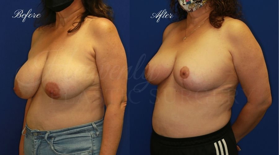 Breast lift surgery, breast lift, breast lift surgeon, mastopexy, mastopexy surgery, breast lift without implants, breast lift orange county, plastic surgery before and after, breast lift before and after, breast lift results, breast reduction, breast reduction results, plastic surgeon, plastic surgery, orange county plastic surgery, orange county plastic surgeon