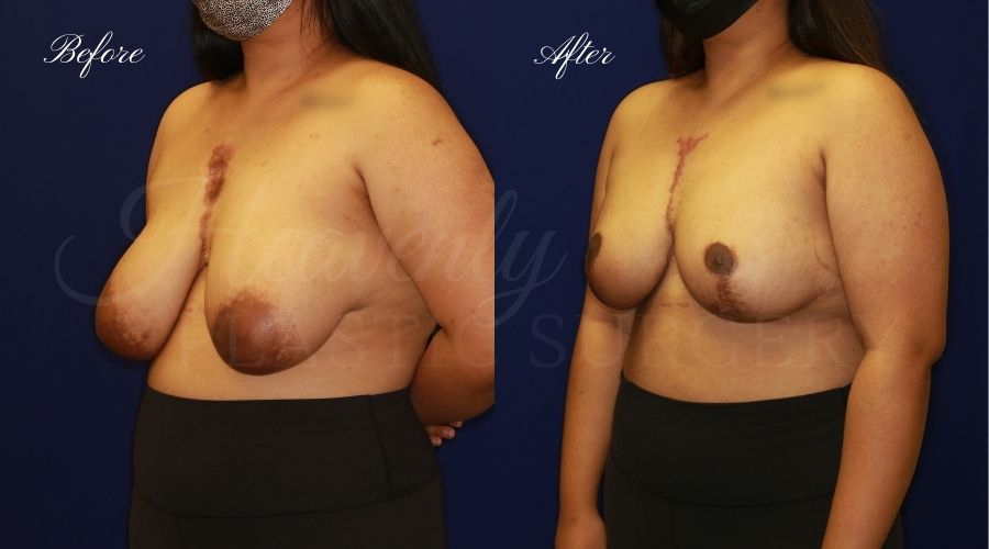 Breast lift surgery, breast lift, breast lift surgeon, mastopexy, mastopexy surgery, breast lift without implants, breast lift orange county, plastic surgery before and after, breast lift before and after, breast lift results, breast reduction, breast reduction results, plastic surgeon, plastic surgery, orange county plastic surgery, orange county plastic surgeon