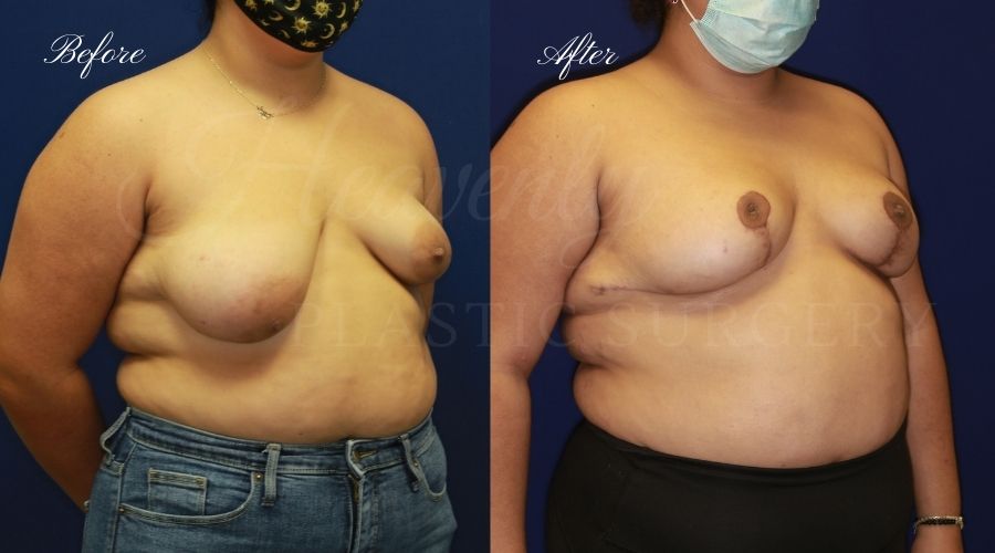 Breast lift surgery, breast lift, breast lift surgeon, mastopexy, mastopexy surgery, breast lift without implants, breast lift orange county, plastic surgery before and after, breast lift before and after, breast lift results, breast reduction, breast reduction results, plastic surgeon, plastic surgery, orange county plastic surgery, orange county plastic surgeon Breast lift surgery, breast lift, breast lift surgeon, mastopexy, mastopexy surgery, breast lift without implants, breast lift orange county, plastic surgery before and after, breast lift before and after, breast lift results, breast reduction, breast reduction results, plastic surgeon, plastic surgery, orange county plastic surgery, orange county plastic surgeon