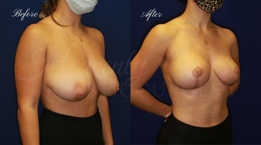 Breast lift surgery, breast lift, breast lift surgeon, mastopexy, mastopexy surgery, breast lift without implants, breast lift orange county, plastic surgery before and after, breast lift before and after, breast lift results, breast reduction, breast reduction results, plastic surgeon, plastic surgery, orange county plastic surgery, orange county plastic surgeon