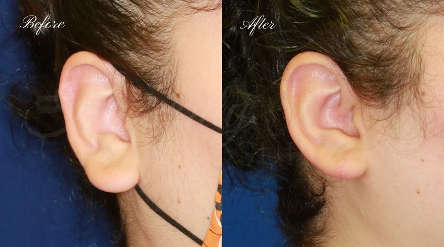 Plastic surgery, plastic surgeon, earlobe repair, before and after