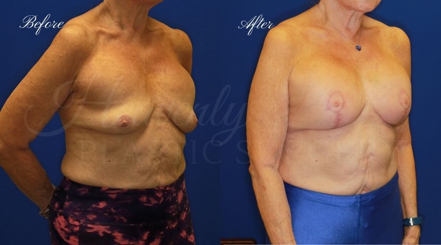 Implant Exchange + Breast Lift Before and After -, Plastic Surgery, Plastic Surgeon, Breast Implant Exchange with Breast LIft, Breast Surgery, Breast surgery before and after, breast implant exchange with lift before and after, plastic surgery orange county, plastic surgeon orange county