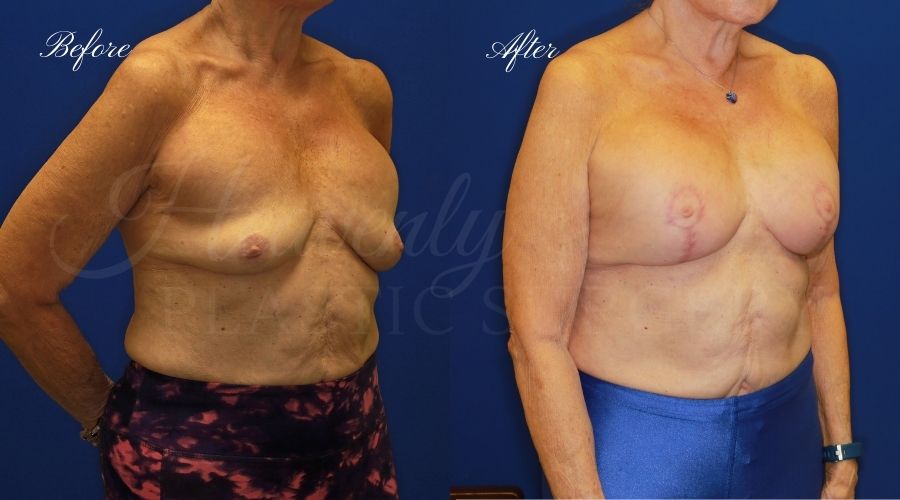 Implant Exchange + Breast Lift Before and After -, Plastic Surgery, Plastic Surgeon, Breast Implant Exchange with Breast LIft, Breast Surgery, Breast surgery before and after, breast implant exchange with lift before and after, plastic surgery orange county, plastic surgeon orange county Implant Exchange + Breast Lift Before and After -, Plastic Surgery, Plastic Surgeon, Breast Implant Exchange with Breast LIft, Breast Surgery, Breast surgery before and after, breast implant exchange with lift before and after, plastic surgery orange county, plastic surgeon orange county