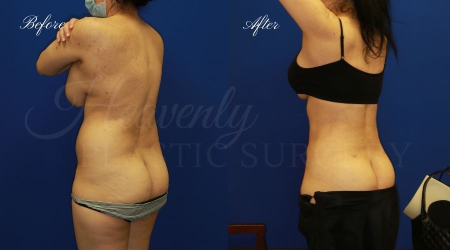 liposuction 360, lipo 360, arm liposuction, liposuction before and after, lipo 360 before and after, arm lipo before and after, chin lipo before and after, liposuction surgeon, liposuction orange county, chin lipo orange county, liposuction results, orange county plastic surgery, orange county plastic surgeon