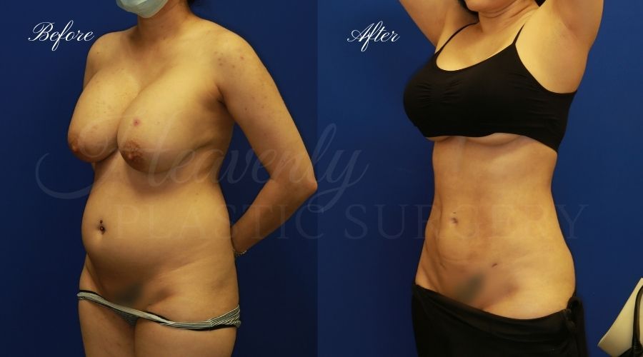 liposuction 360, lipo 360, arm liposuction, liposuction before and after, lipo 360 before and after, arm lipo before and after, chin lipo before and after, liposuction surgeon, liposuction orange county, chin lipo orange county, liposuction results, orange county plastic surgery, orange county plastic surgeon