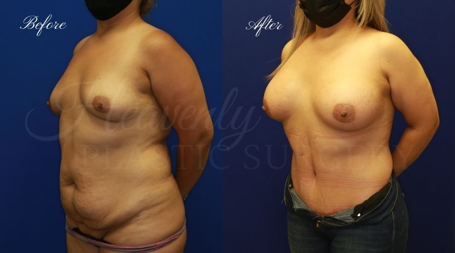 Mommy makeover before and after, breast augmentation before and after, tummy tuck before and after, mommy makeover results, mommy makeover surgeon, breast augmentation surgeon, breast implant surgeon, breast implant surgery, tummy tuck surgeon, abdominoplasty, abdominoplasty surgeon, orange county plastic surgeon, breast implants orange county, tummy tuck orange county, orange county plastic surgeon