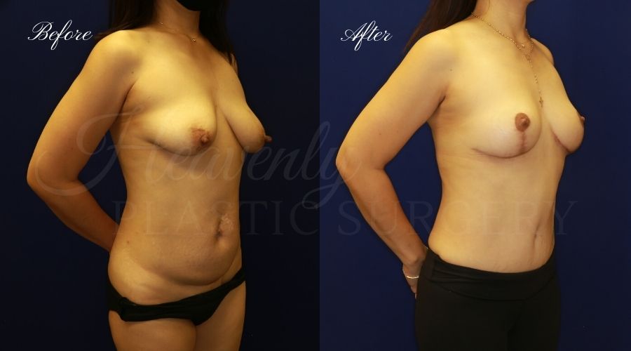 Heavenly Plastic Surgery, Plastic Surgery, Plastic Surgeon, Mommy Makeover, Transformation, Breast Lift, Tummy Tuck, Breast lift without implants, Breast Surgery, Body Surgery, Tummy Tuck, Tummy Tuck with Liposuction, Liposuction