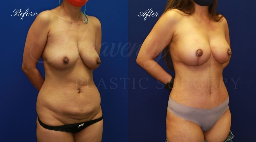 Mommy makeover before and after, mommy makeover surgery, breast lift surgery, tummy tuck surgery, breast lift before and after, tummy tuck before and after, mommy makeover surgeon, mommy makeover surgery, mommy makeover orange county, tummy tuck orange county, breast lift orange county, plastic surgery, plastic surgeon, plastic surgery before and after, mommy makeover journey, mommy makeover results, tummy tuck journey, tummy tuck results, plastic surgery results, orange county plastic surgeon, orange county plastic surgery, plastic surgery orange county Mommy makeover before and after, mommy makeover surgery, breast lift surgery, tummy tuck surgery, breast lift before and after, tummy tuck before and after, mommy makeover surgeon, mommy makeover surgery, mommy makeover orange county, tummy tuck orange county, breast lift orange county, plastic surgery, plastic surgeon, plastic surgery before and after, mommy makeover journey, mommy makeover results, tummy tuck journey, tummy tuck results, plastic surgery results, orange county plastic surgeon, orange county plastic surgery, plastic surgery orange county