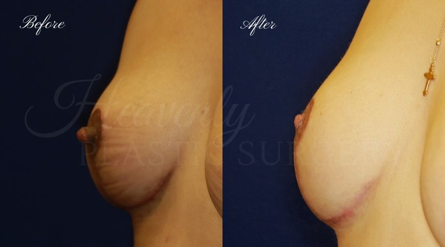 nipple reduction, nipple reduction surgery, nipple reduction surgeon, nipple surgery, plastic surgery, plastic surgeon, nipple reduction orange county, nipple surgery orange county, orange county plastic surgeon, orange county plastic surgery