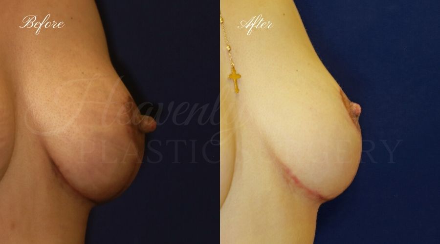 nipple reduction, nipple reduction surgery, nipple reduction surgeon, nipple surgery, plastic surgery, plastic surgeon, nipple reduction orange county, nipple surgery orange county, orange county plastic surgeon, orange county plastic surgery