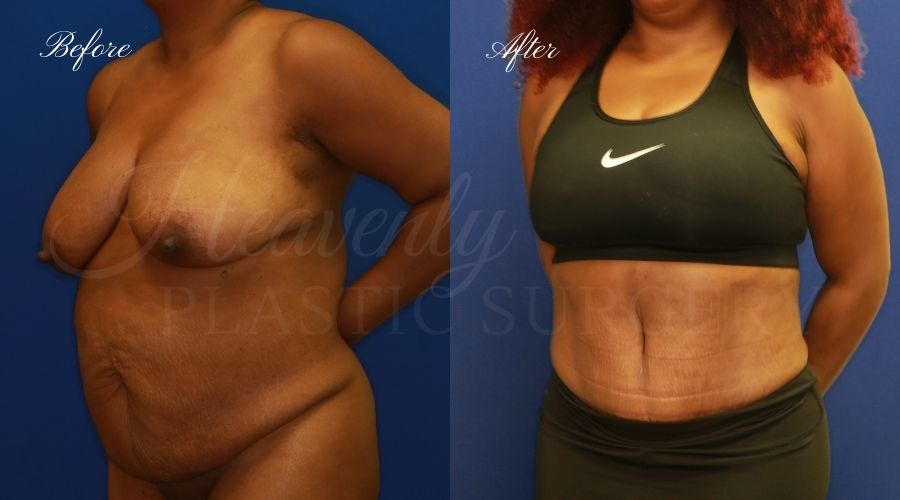 Plastic Surgery, Plastic Surgeon, Tummy Tuck, Abdominoplasty, Tummy Tuck with Lipo, Liposuction, Orange County Plastic Surgeon, Orange County Plastic Surgery, Fupa, Fupa surgery, fupa surgeon