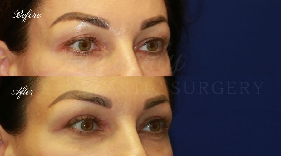 Plastic Surgery, Plastic Surgeon, Eyelid Surgery, Upper blepharoplasty, blepharoplasty, upper eyelids, upper eyelid surgery