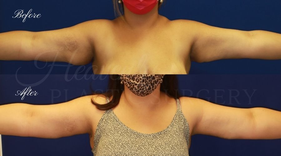 arm lift, extra arm skin, flabby arms, brachioplasty, before and after arm lift, plastic surgery, plastic surgeon, arm lift specialist, arm lift expert