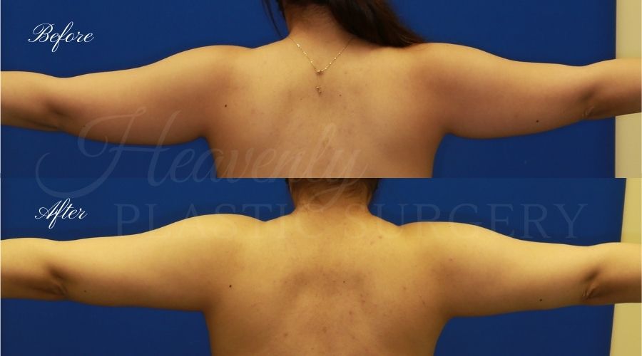 liposuction 360, lipo 360, arm liposuction, liposuction before and after, lipo 360 before and after, arm lipo before and after, chin lipo before and after, liposuction surgeon, liposuction orange county, chin lipo orange county, liposuction results, orange county plastic surgery, orange county plastic surgeon liposuction 360, lipo 360, arm liposuction, liposuction before and after, lipo 360 before and after, arm lipo before and after, chin lipo before and after, liposuction surgeon, liposuction orange county, chin lipo orange county, liposuction results, orange county plastic surgery, orange county plastic surgeon