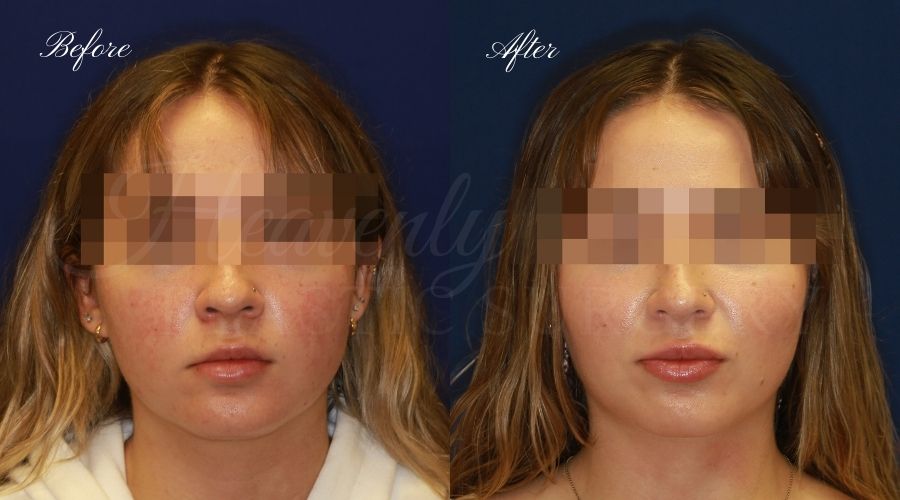 Buccal Fat Pad Removal, Buccal Fat Pad Removal Surgery, Cheekbone surgery, Cheek Plastic Surgery, Cheekbone Plastic Surgery, Cheek Surgery, Cheek Plastic Surgery, Contour Buccal Fat Pad Removal, Buccal Fat Pad Removal Surgery, Cheekbone surgery, Cheek Plastic Surgery, Cheekbone Plastic Surgery, Cheek Surgery, Cheek Plastic Surgery, Contour
