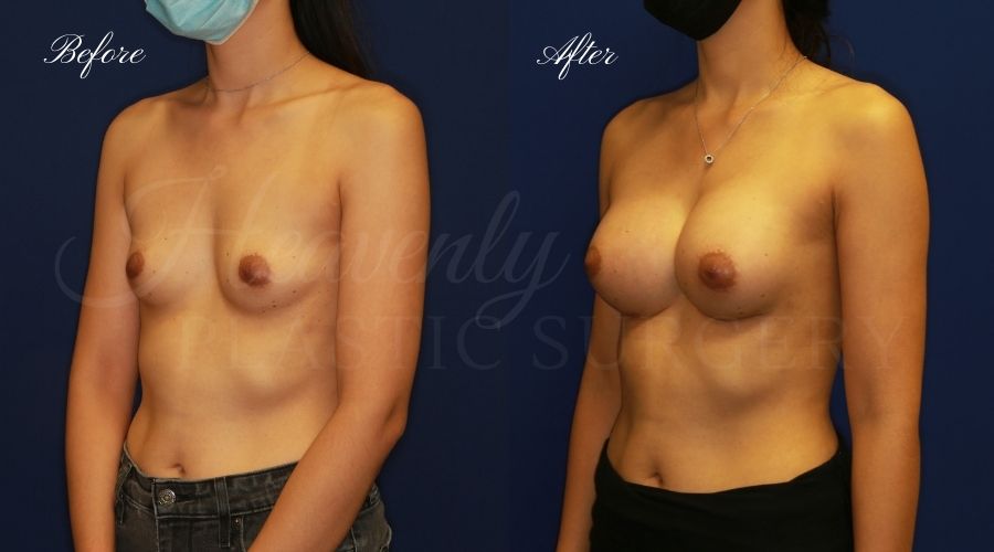 breast augmentation, breast augmentation surgery, breast augmentation surgeon, breast augmentation orange county, breast augmentation with silicone implants, sientra implants, boob job, boob job surgeon, breast implant surgeon, plastic surgery orange county, lake forest plastic surgeon, breast augmentation lake forest, south oc plastic surgeon