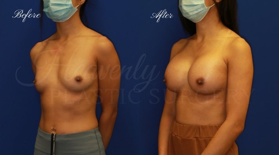 breast augmentation, breast augmentation surgery, breast augmentation surgeon, breast augmentation orange county, breast augmentation with silicone implants, sientra implants, boob job, boob job surgeon, breast implant surgeon, plastic surgery orange county, lake forest plastic surgeon, breast augmentation lake forest, south oc plastic surgeon