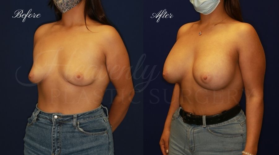 breast augmentation, breast augmentation surgery, breast augmentation surgeon, breast augmentation orange county, breast augmentation with silicone implants, sientra implants, boob job, boob job surgeon, breast implant surgeon, plastic surgery orange county, lake forest plastic surgeon, breast augmentation lake forest, south oc plastic surgeon