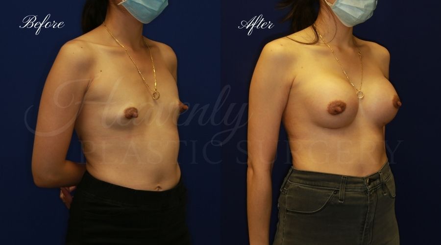 breast augmentation before and after, breast augmentation results, breast augmentation surgery, breast implants before and after, breast implants results, plastic surgery before and after, plastic surgery results, plastic surgeon, breast surgeon, breast augmentation surgeon, breast implant surgeon, breast implants orange county, breast augmentation orange county, orange county plastic surgeon, plastic surgery check