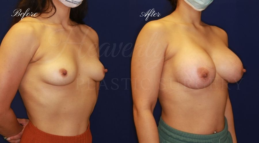 505cc, 505 cc, high profile, breast augmentation, breast augmentation surgery, breast augmentation surgeon, breast augmentation orange county, breast augmentation with silicone implants, sientra implants, boob job, boob job surgeon, breast implant surgeon, plastic surgery orange county, lake forest plastic surgeon, breast augmentation lake forest, south oc plastic surgeon 505cc, 505 cc, high profile, breast augmentation, breast augmentation surgery, breast augmentation surgeon, breast augmentation orange county, breast augmentation with silicone implants, sientra implants, boob job, boob job surgeon, breast implant surgeon, plastic surgery orange county, lake forest plastic surgeon, breast augmentation lake forest, south oc plastic surgeon