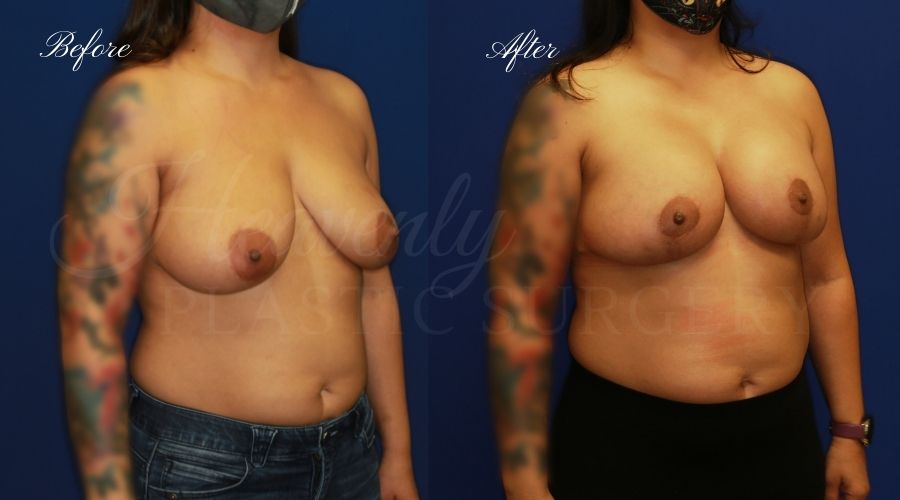 Breast Lift with Implants (Mastopexy-Augmentation) Before and After, Breast lift with implants orange county, plastic surgery before and after, plastic surgery orange county, breast surgery orange county, boob job orange county, boob job california