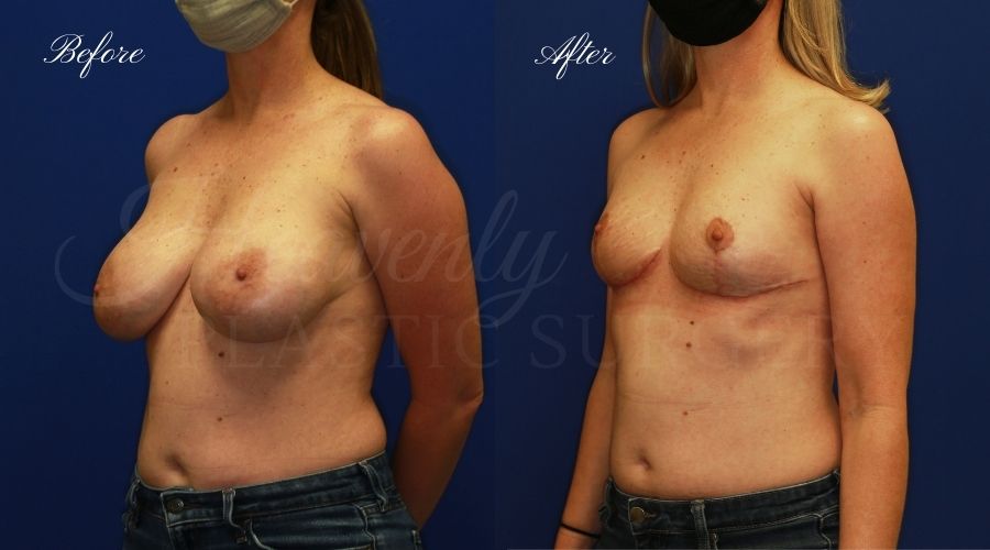 Breast Implant Removal + Breast Lift, Explant and Breast Lift, Breast Explant, Mastopexy, IMplant removal and mastopexy, plastic surgery before and after, plastic surgery revision, implant removal before and after, breast implant removal before and after, breast implant removal surgeon, breast implant removal orange county