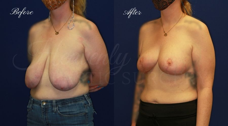 Breast Lift Before & After- Left Oblique- MISM Breast lift surgery, breast lift, breast lift surgeon, mastopexy, mastopexy surgery, breast lift without implants, breast lift orange county, plastic surgery before and after, breast lift before and after, breast lift results, breast reduction, breast reduction results, plastic surgeon, plastic surgery, orange county plastic surgery, orange county plastic surgeon, deflated breast surgery, mommy surgery
