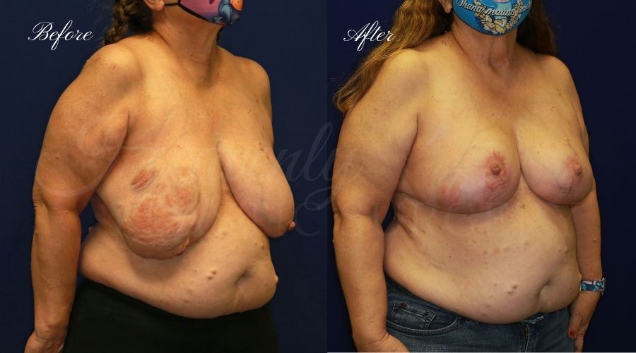 Breast Reduction Before and After, Plastic surgery, plastic surgeon, breast reduction, breast lift, reduction mammaplasty, mastopexy, before and after, mastopexy
