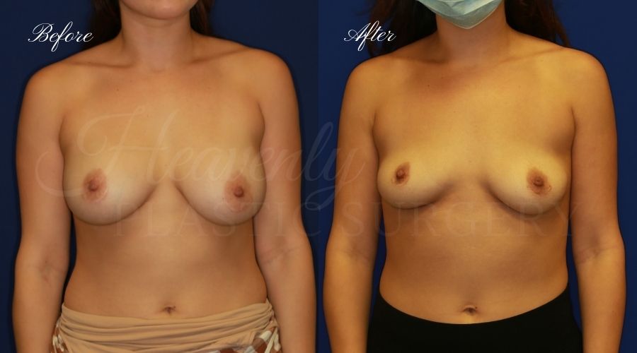 explant, implant removal, breast implant removal, breast implant removal without lift, breast explant, breast implant explant, bii, breast implant illness explant, implant removal, breast implant removal, breast implant removal without lift, breast explant, breast implant explant, bii, breast implant illness