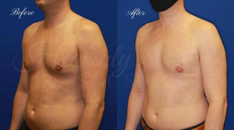 gynecomastia before and after, gynecomastia treatment, gynecomastia results, gynecomastia excision, gynecomastia surgeon, gynecomastia orange county, moobs, man boobs, man boob surgery, male breast tissue, male breast tissue surgery, plastic surgery before and after, plastic surgeon, orange county plastic surgeon, orange county plastic surgery