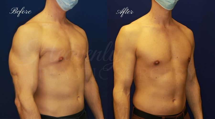 Heavenly Plastic Surgery, plastic Surgery, PLastic Surgeon, Gynecomastia, Man Boobs, male breasts, breast surgery, man boob sugery Heavenly Plastic Surgery, plastic Surgery, PLastic Surgeon, Gynecomastia, Man Boobs, male breasts, breast surgery, man boob sugery