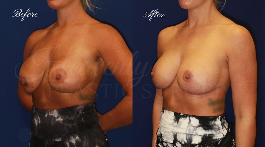 Breast Implant Exchange and Breast Lift - 310cc SRM Silicone Implants with Wise pattern Mastopexy (Anchor Scar)