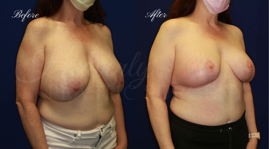 Breast Implant Exchange and Breast Lift - 310cc SRM Silicone Implants with Wise pattern Mastopexy (Anchor Scar)