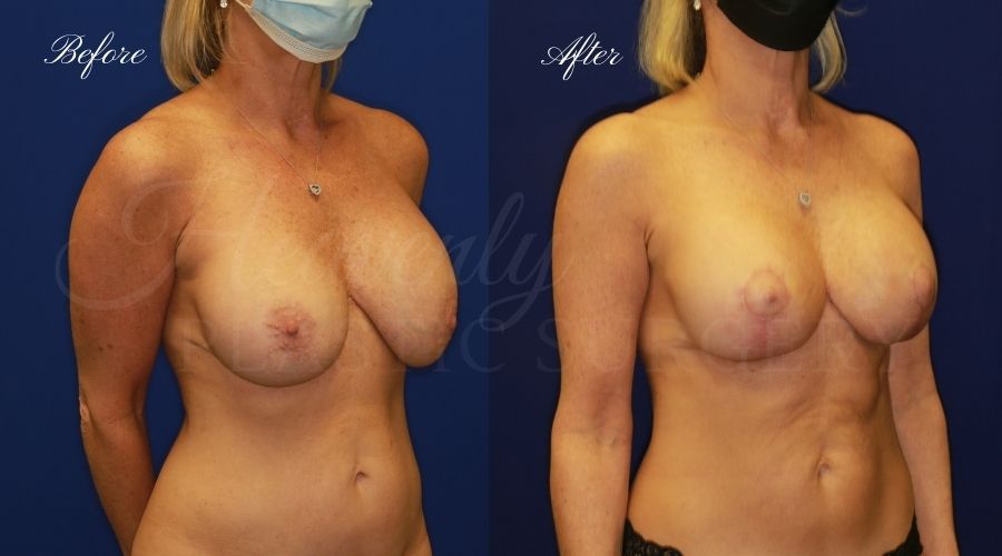 Breast Implant Exchange and Breast Lift - 310cc SRM Silicone Implants with Wise pattern Mastopexy (Anchor Scar)